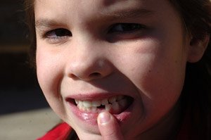 lakewood-elementary-school-first-grader-hannah-aderholt-7-shows-her-missing-tooth