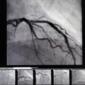 A video display shows the moment the balloon is inflated to restore blood flow to the blocked portio...