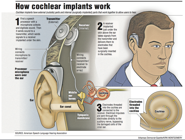 This Graphic Shows How Cochlear Implants Work